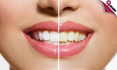 Teeth Whitening + Scaling & Polishing!
